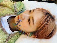 コス(KOS)/美容鍼