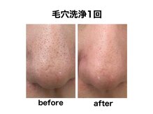 マスカレード 品川(Masquerade)/【症例写真】施術1回