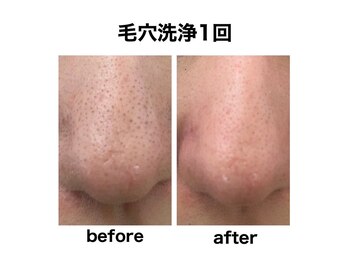 マスカレード 品川(Masquerade)/【症例写真】施術1回