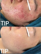 ビーピー 渋谷(b.p.)/TIPハーブピーリング　