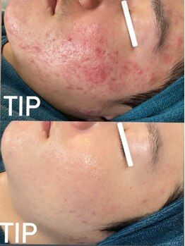 ビーピー 渋谷(b.p.)/TIPハーブピーリング