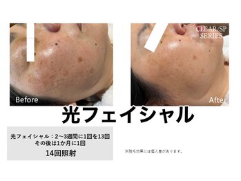 サロン シェリー 大島(Salon Cherie)/光フェイシャル