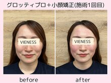 ヴィーネス(VIENESS)/【グロッティプロ＋小顔矯正】