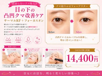 オリエンタルローザ 表参道(Oriental Rosa)/バレない！ 目の下のクマ取り！