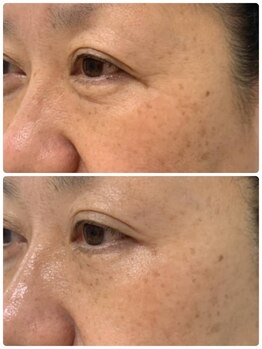 リュミエール デスポワール(Lumiere d'espoir)/ハーブピーリング