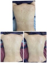 リコリナ(LikoLina)/陶肌トリートメント背中