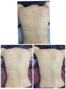 リコリナ(LikoLina)/陶肌トリートメント背中