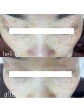 ブランシェ 野々市店 × 椿/シミケア　お客様