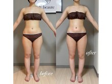 エヌボーテ(N. beaute)/before→after5回目