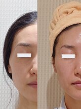 アルマ 芦屋(ALMA)/はっきりわかる変化♪右比較