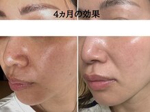 ミルアカ(Milu'aca)の雰囲気（剥離が目的ではないハーブピーリングで40代からの美が変わる）