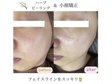 サクラ(SAKURA)の雰囲気（ちょっと痛いけど効果抜群な小顔矯正&ハーブピーリングセット☆）