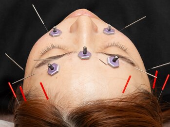 ふなと川接骨院 倉賀野院/眼精疲労の鍼施術【高崎　鍼灸】