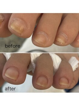 足の甘皮ケアですっきり!