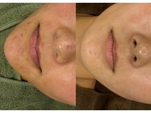 肌質改善専門【Salon da Mahina】毛穴ケア/ニキビケア/ハーブピーリング/ニキビ/毛穴/ハーブピーリング