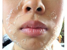 ピアリーノ(Pialino)/ハーブピーリング剥離の例