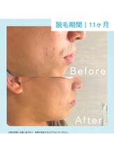 メンズクリア アスピア明石店/【メンズクリア】お客様の施術例