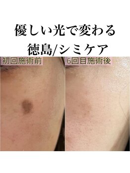 サロンツキ(salon tuki)/肌質改善の過程で叶えるシミケア