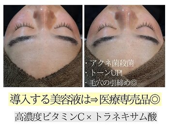 アースコアフュールボーテ ひたち野うしく店(EARTH coiffure beaute)/プラズマシャワー 美容液導入♪