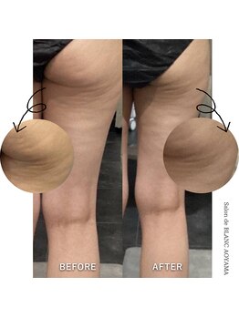 サロン ド ブラン アオヤマ(Salon de BLANC AOYAMA)/スリミングボディbefore・after