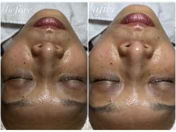 スパークル/ワックス/脱毛/毛穴/小顔