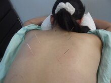 アタック鍼灸院(ATAC鍼灸院)/背部への刺鍼