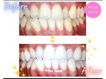 エクシアホワイトニング 旭橋店/ビフォーアフター