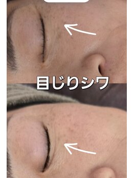 ボディキュア グランド(Body cure Grand)/一番気になる目じりシワ