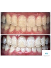 ホワイトニングショップ 奈良生駒店/回数券の方のBefore After 