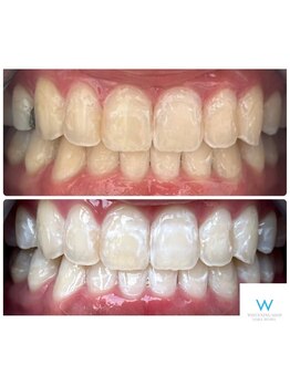 ホワイトニングショップ 奈良生駒店/回数券の方のBefore After 