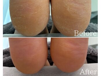 カシェット 広島店(Cachette)/50代女性☆足裏角質ケア90分