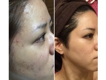 リュミエール デスポワール(Lumiere d'espoir)/ハーブピーリング