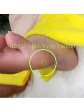 ドクターネイル爪革命 長野店/【たこ・うおのめ】リラク/足裏