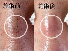 ベルネ(bellne)の雰囲気（頑固な黒ずみ毛穴も！）