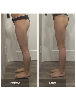 トータルビューティ リライフ(Total beauty Relife)/ウルトランス下半身