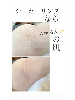 脱毛 ピーリングサロン M/脇　シュガーリング