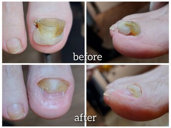 【肥厚爪】～自爪育成～