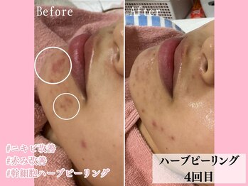 エン クリニカルラボ(E&N CLINICAL LABO)/気になる顎下ニキビに