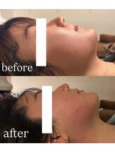 サロン ニコリー(Salon Nicolly)/レモンボトル3cc1回施術後