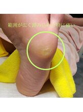 ドクターネイル爪革命 長野店/【たこ・うおのめ】リラク/足裏