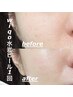 【サロンで叶える韓国ツヤ肌ケア】WIQO水光ピーリング　