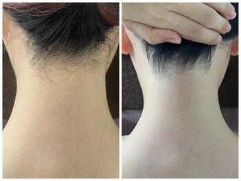 シロ(Shiro)/うなじのデザイン脱毛