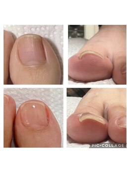 TOEMED巻き爪ケア