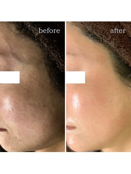 マーギアー(Magier)/ハーブ＋ダーマ　初来店→5回目