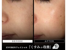 メディケア 新宿/ENVIRON フルコース【くすみ】