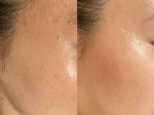 シャイネル(SHYNELL)/ハーブリプロ1回のお写真です！