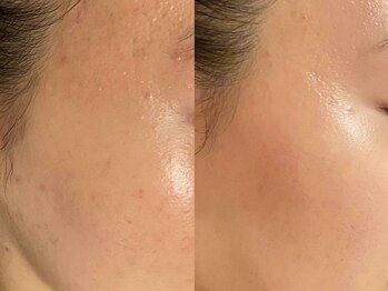 シャイネル(SHYNELL)/ハーブリプロ1回のお写真です!