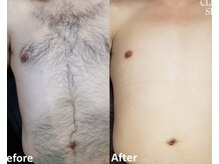 アップパイン(UPPINE)/胸お腹脱毛/大国町