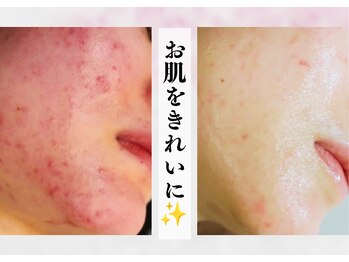 リヴェーヌ 富山店の写真/【素肌を育てる方法で、根本改善◎】あなたに合わせたやり方で、豊富な知識のプロが全力でフォローします！