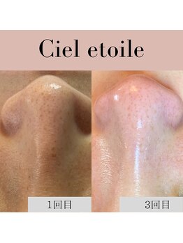 シエルエトワレ/毛穴エクストラクション